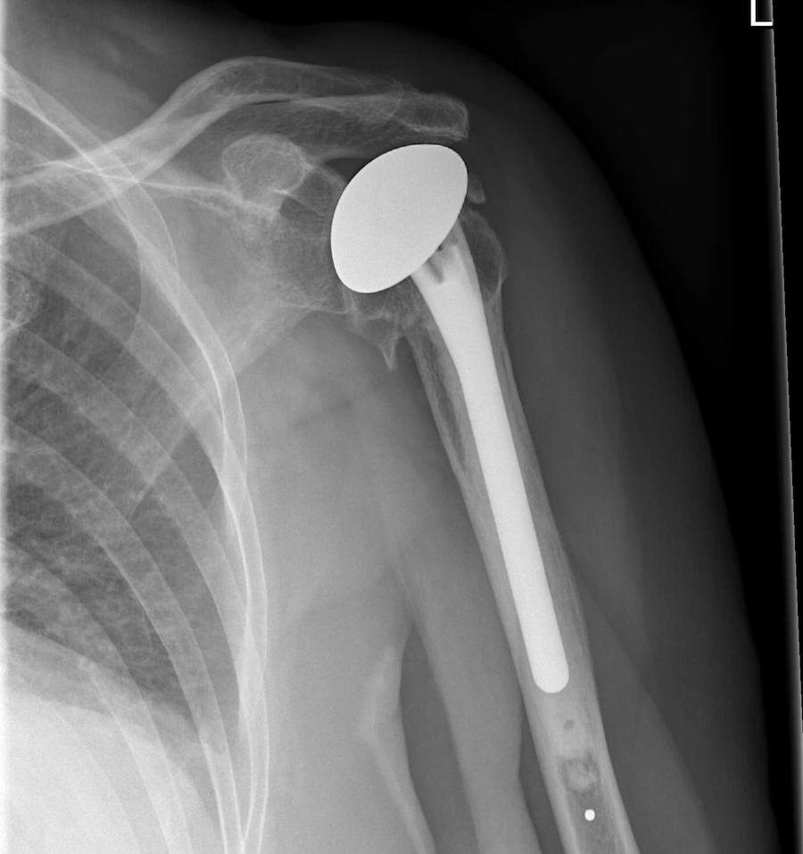 X-ray of a shoulderprotesis / replacement