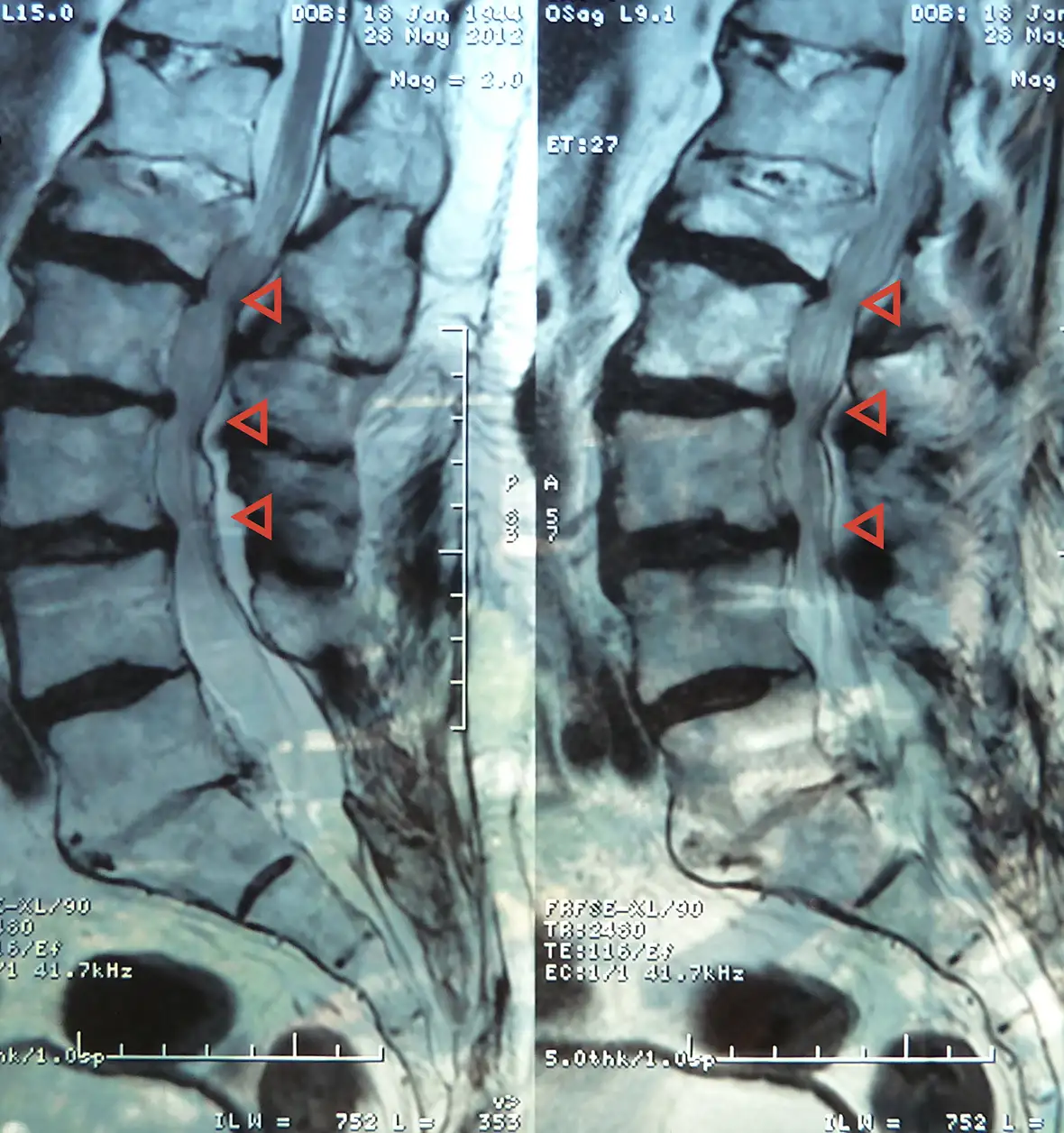 Massage therapy in a rustic setting.